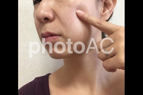 しみ 法令線 しみ 法令線の写真