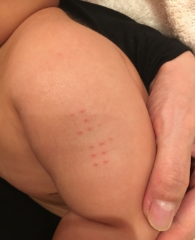 bcg はんこ 注射