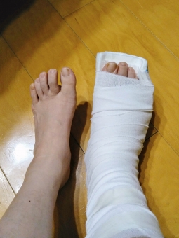 足を骨折しました